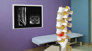 spinal stenosis